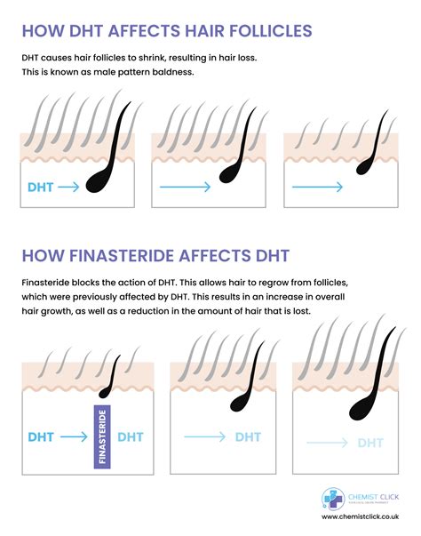 How and when to take finasteride .